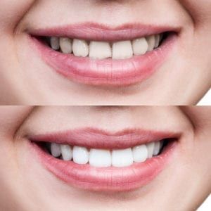 hopmeadow dental teeth whitening before after
