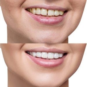 hopmeadow dental teeth whitening before after